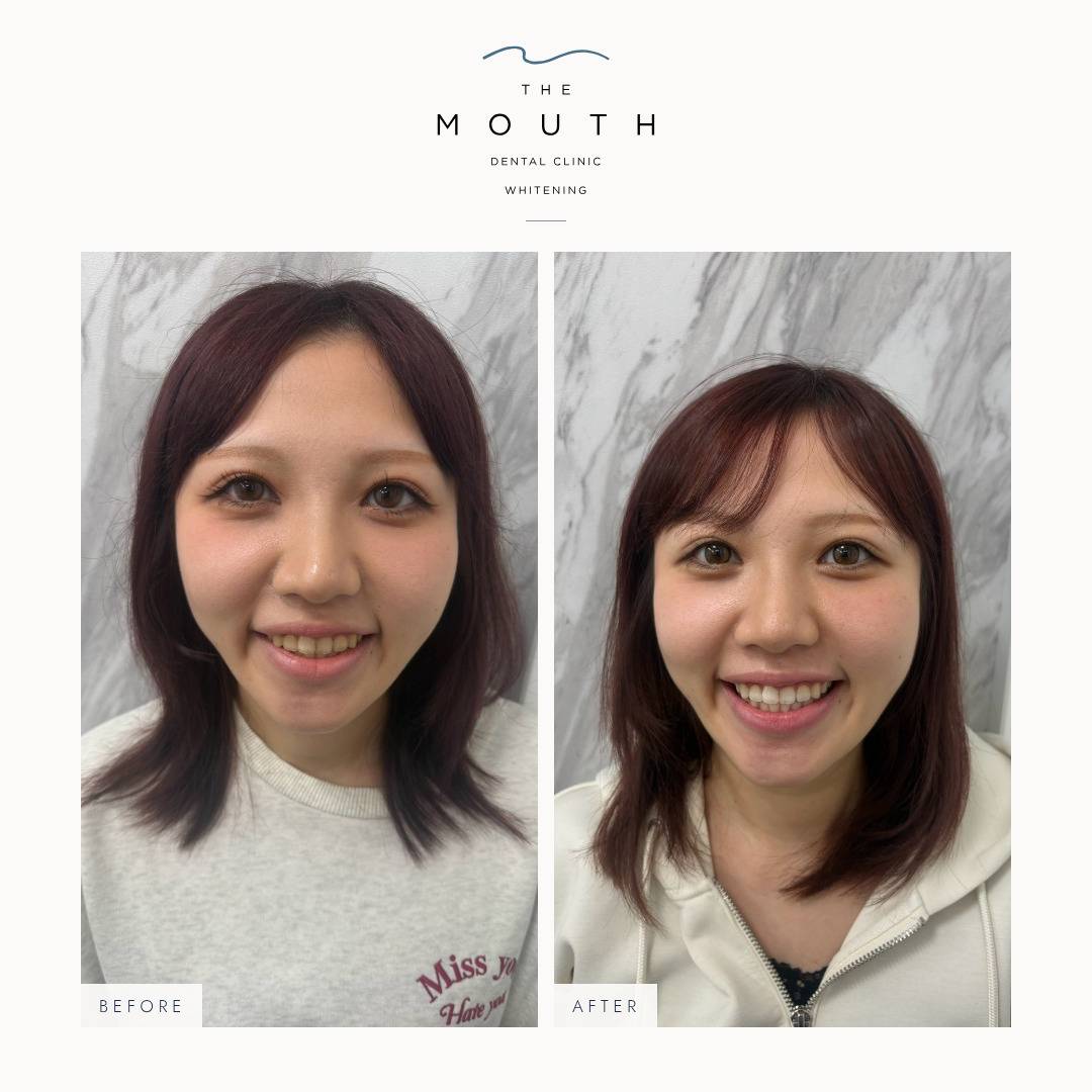 1DAYメディカルホワイトニング（2回・約1週間・女性）